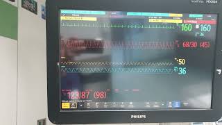 Fluke Prosim 8 Philips MX800 amp X3 with Neonatal Manikin [upl. by Auhso]