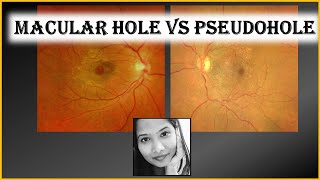 Macular Hole Vs Pseudohole  Retina  Ophthalmology [upl. by Ytissac335]