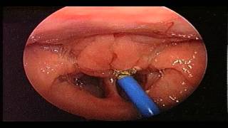 Adenoidectomy Surgery  Removal Of Adenoids  ENT Consultant London  ENT Surgeon London [upl. by Susej]