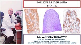 FOLLICULAR LYMPHOMA PART1 BY DR WAFAEY BADAWY [upl. by Eidnim]