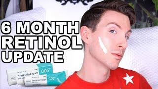 FIRST 6 MONTHS ON RETIN A  BEFORE AND AFTER TRETINOIN CREAM [upl. by Akvir841]