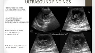 Gangrenous cholecystitis  A rare Entity [upl. by Coppola]