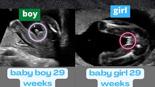 Ultrasound Showing a Boy and a Girl Baby Both at 29 Weeks [upl. by Derian]