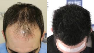 FUE Hair Transplant 3467  1000 grafts in NW  Class IV  A Dr Juan Couto  FUEXPERT CLINIC [upl. by Kerek]