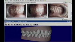 Invisalign Herstellung  deutsch [upl. by Alrad]