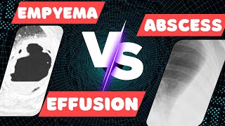 Empyema vs Lung Abscess vs Pleural Effusion on IMAGING [upl. by Ahsertal800]