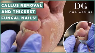 Callus removal from feet and thick toenails cutting treatment  DG Podiatrist The Foot Scraper [upl. by Oalsinatse]