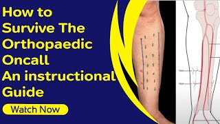 How to Survive The Orthopaedic Oncall  An instructional Guide [upl. by Lesly]