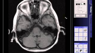 BRAIN MRI OLD INFARCTION [upl. by Owain]