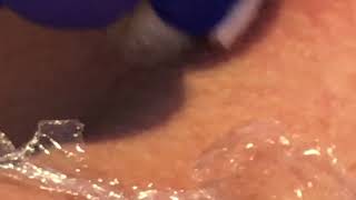 Skin Tag Removal During Plasma Pen Training By Plasmasthetics [upl. by Ahsimak]