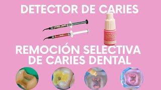 Detector de Caries y Remoción de Caries Selectiva [upl. by Engelbert]