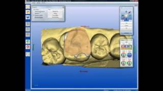 CEREC AC Onlay Restoration [upl. by Carlock]