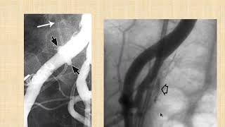 Ureteral Stents Complications and Innovations [upl. by Goldsmith]