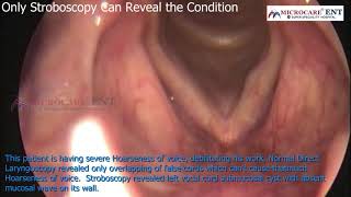 Only Stroboscopy Can Reveal the Condition Voice Surgeon Dr Vinnakota Sriprakash Microcare ENT [upl. by Roux]