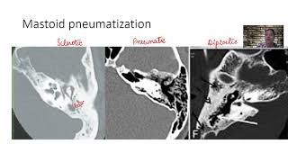 temporalbone and sphenoid pneumatization [upl. by Sirahc]