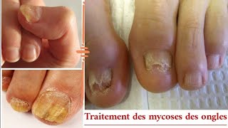 Traite les mycoses des ongles et traite les peaux mortes sous longle [upl. by Nosned]