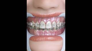 How braces work braces teeth satisfying [upl. by Otrevire]