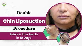 Double Chin Liposuction Procedure Before amp After Results in 10 Days  Care Well Medical Centre [upl. by Ydaj]