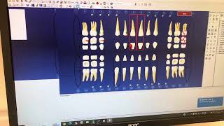 Reset your Dentrix Chart dentrix dental dentalsoftware dentalhygiene dentalhygienist [upl. by Durkin]