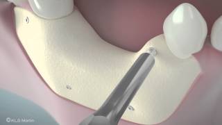 SonicWeld Rx® Dental – Shell technique for vertical defect augmentation [upl. by Jake586]