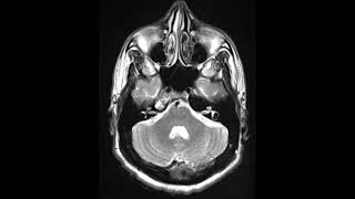 Asymmetric pneumatization petrous portion temporal bone [upl. by Idurt387]