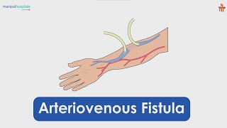 Arteriovenous Fistula  Manipal Hospitals Bengaluru [upl. by Asuncion353]