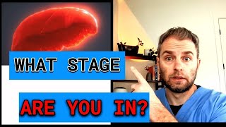 Decoding Hemochromatosis Stages [upl. by Adnelg]