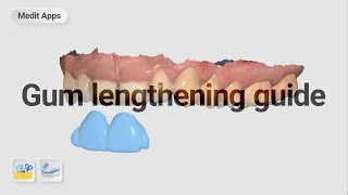 Designing a gumcrown lengthening guide with Medit apps [upl. by Noned752]