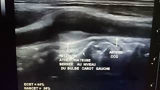 Échodoppler des TSA Sténose athéromateuse serrée [upl. by Canfield]