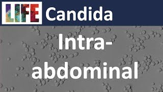 Intraabdominal candidiasis [upl. by Amalbergas509]