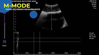 Pathway US Imaging for Lumbopelvic Rehab New Software [upl. by Deyas]