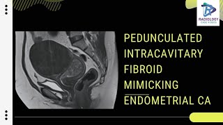 Pedunculated intracavitory fibroid vs Endometrial carcinoma  Umamaheswara ReddyV [upl. by Julianne64]