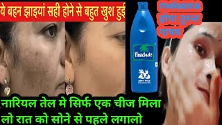 काली गहरी melasma को करे 💯 तुरन्त गायब आपने चेहरे को बनाये चमकदार pigmentation removal home remedy [upl. by Anthea]