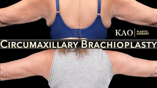 KAO Plastic Surgery Arm Lift Without The Huge Scars  Circumaxillary Brachioplasty  Arm Tightening [upl. by Eolcin]