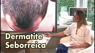 Dermatite Seborreica e Caspa  Conheça as diferenças [upl. by Coad972]