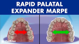 Rapid PALATAL expander MARPE  This ORTHODONTIC device can EXPAND the PALATE in adults© [upl. by Bette-Ann]