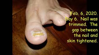 Fenben v Fungal Nail an Experimental Treatment of Fungal Nail with Fenben [upl. by Ahsan323]