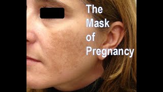 Melasma The Mask of Pregnancy Lichen Simplex Chronicus and What the Heck Is Eczema [upl. by Yrrac]