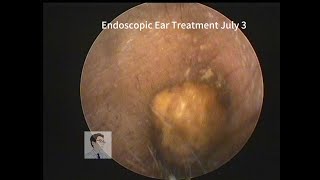 asmr ear cleaning Cerumen embolism in adults20230703 [upl. by Iarahs853]