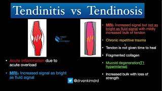 Tendinitis VS Tendinosis  Simplified [upl. by Claudian]