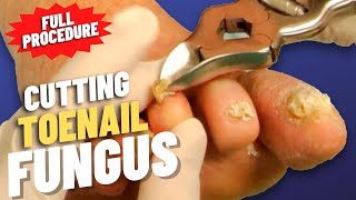 Cutting THICK Toenails [upl. by June672]