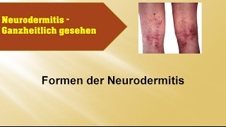 Formen der Neurodermitis  GANZMEDIZIN Naturheilpraxis [upl. by Athal109]