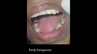 Dental bridge  ස්ථිර දත් සවිකිරීම [upl. by Jessalin]