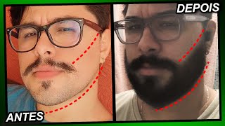 EVOLUÇÃO MINOXIDIL 1 ANO E 4 MESES Pant Foligain e Kirkland [upl. by Oilasor846]