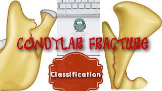 CONDYLAR FRACTURE CLASSIFICATION [upl. by Eissalc248]