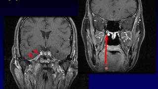 Imaging of the Nasopharynx [upl. by Nilyram]