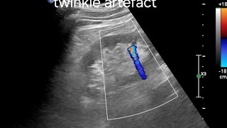 Identifying Renal Stones with Twinkle Artefact A Key Ultrasound and Color Doppler Feature [upl. by Asaeret]