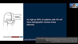 Up to 90 of IIH patients will have radiographic venous sinus stenosis  Visish Srinivasan MD [upl. by Acsisnarf]