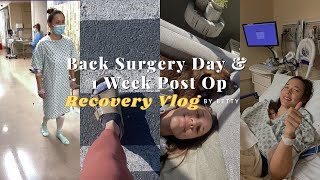 L5S1 Laminectomy  Microdiscectomy Surgery Day amp 1 Week Post Op  Recovery by Betty [upl. by Ynaiffit]