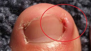 how to treat an ingrown toenail with epsom salt fast [upl. by Nollat]